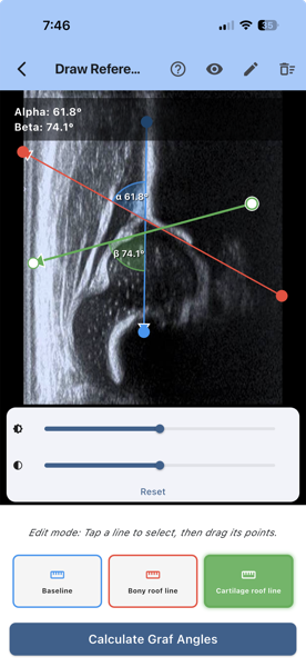 HipAngle Pro measurement screen: infant hip ultrasound with the baseline, bony roof line and cartilage roof line drawn, showing the alpha and beta angles